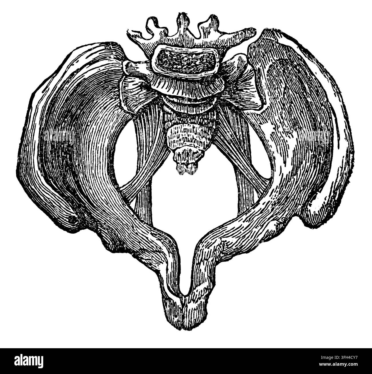 Illustrazione anatomica antica che mostra la grave deformazione ossea del bacino umano causata dall'osteoporosi (ammorbidimento delle ossa). Xilografia autentica di Foto Stock