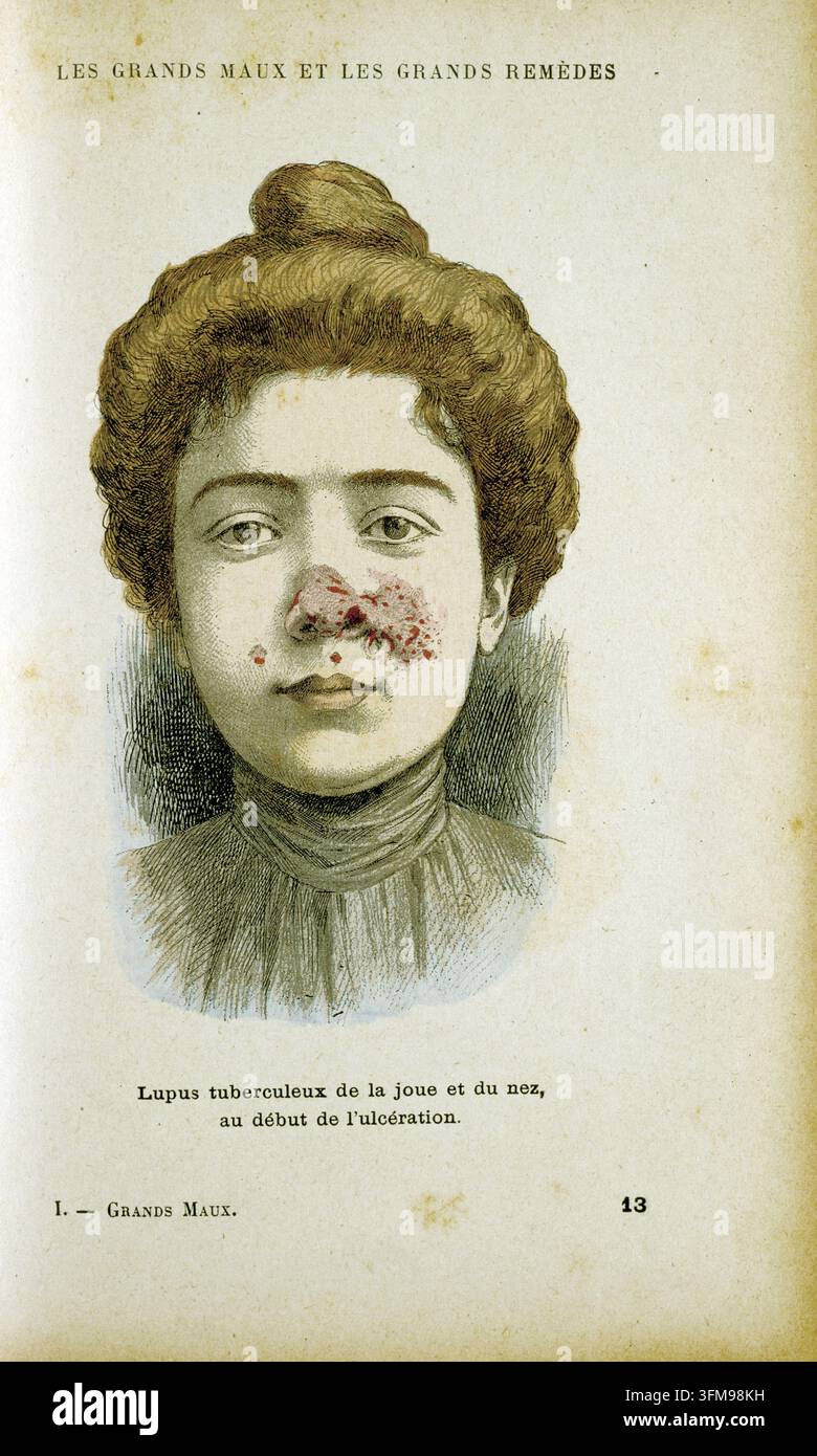 Una litografia a colori raffigurante una donna affetta da lupus vulgaris, una forma di tubercolosi cutanea, con lesioni ulcerate visibili sul naso e sulla guancia. Questa tavola anatomica è stata pubblicata nell'enciclopedia medica Les Grands Maux et les Grands Remèdes (Grandi Malattie e Grandi Rimedi) dal Dr Jules Rengade (1841–1915). L'illustrazione è servita come documento clinico della progressione della malattia durante un periodo in cui era una condizione cronica e altamente deturpante senza trattamento antibiotico moderno. c.1890. Foto Stock