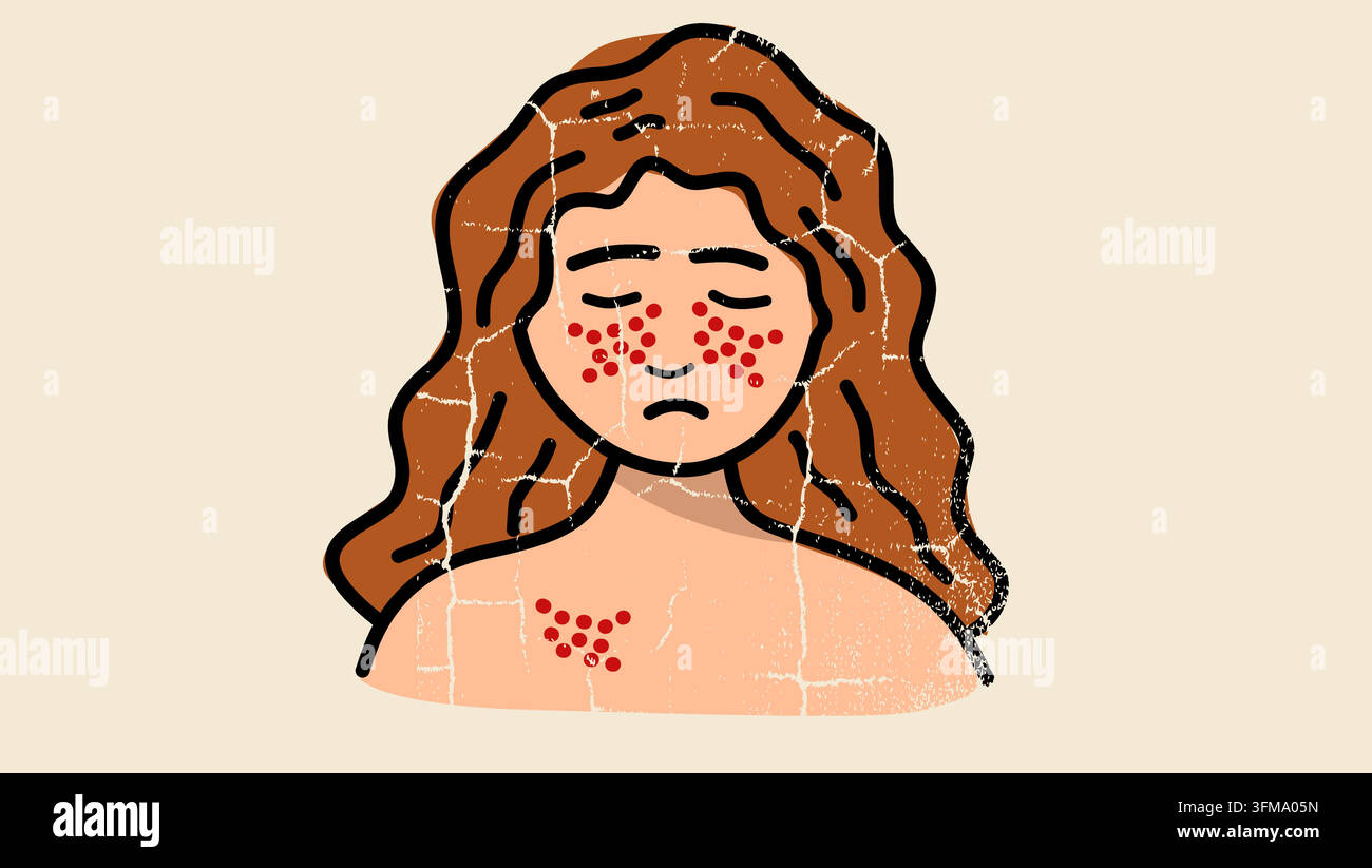 Lupus cutaneo, illustrazione vettoriale a colori Illustrazione Vettoriale
