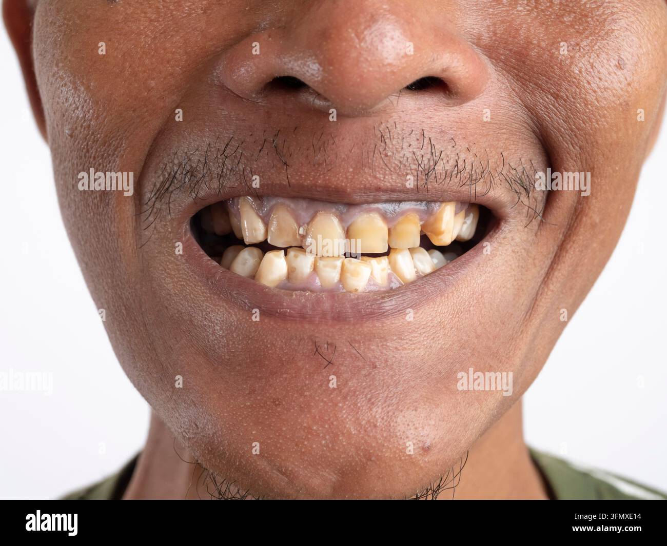 Ritratto ravvicinato di un uomo che mostra denti con tartaro. Denti con molto tartaro, placca. Malocclusione, denti storti. Concetto di denti malsani che hanno bisogno di cure Foto Stock