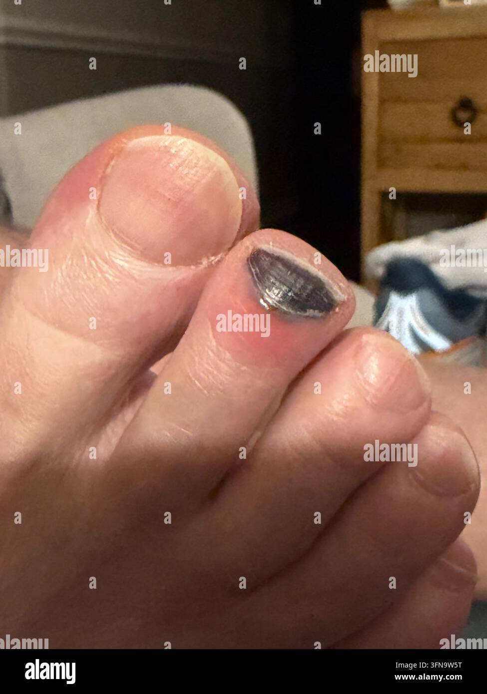 Primo piano di un piede che mostra un'unghia del piede scura e contusa con una visibile decolorazione sotto l'unghia. L'immagine evidenzia l'aspetto di un'unghia danneggiata o in Foto Stock