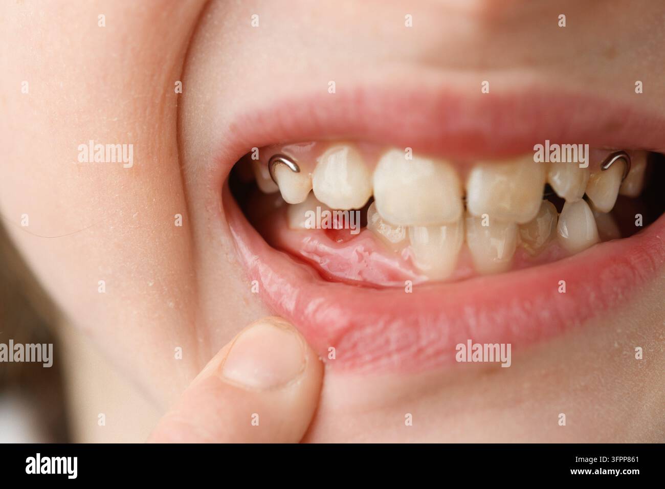 Primo piano mostra il sorriso di un bambino con una lacuna fresca dopo la perdita del dente da latte, una piccola macchia di sangue e un apparecchio ortodontico durante il cambio dei denti. Foto Stock