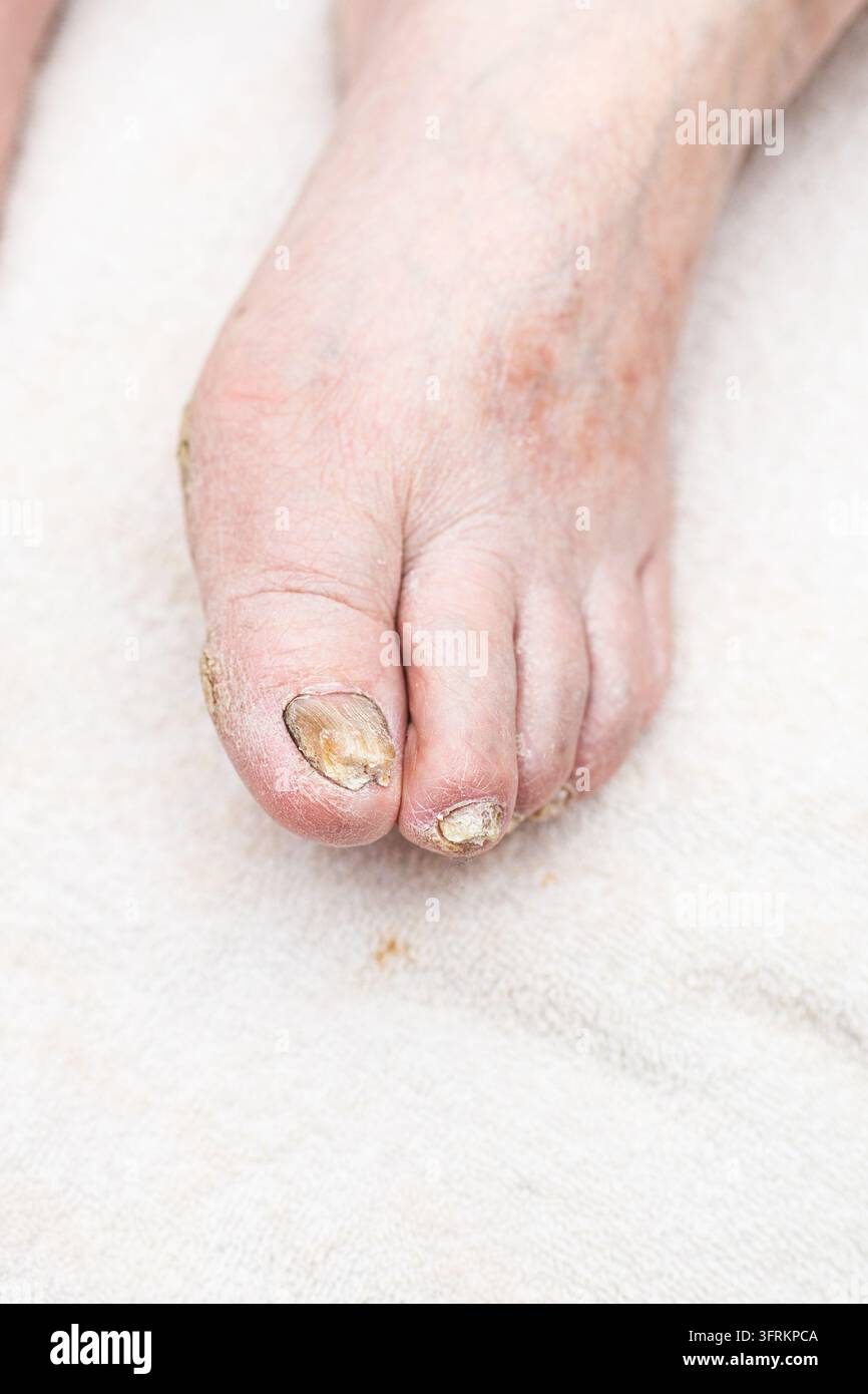 Problema di salute dei piedi negli anziani con infezione fungina delle unghie dei piedi e pelle secca con spazio di copia verticale. Foto Stock