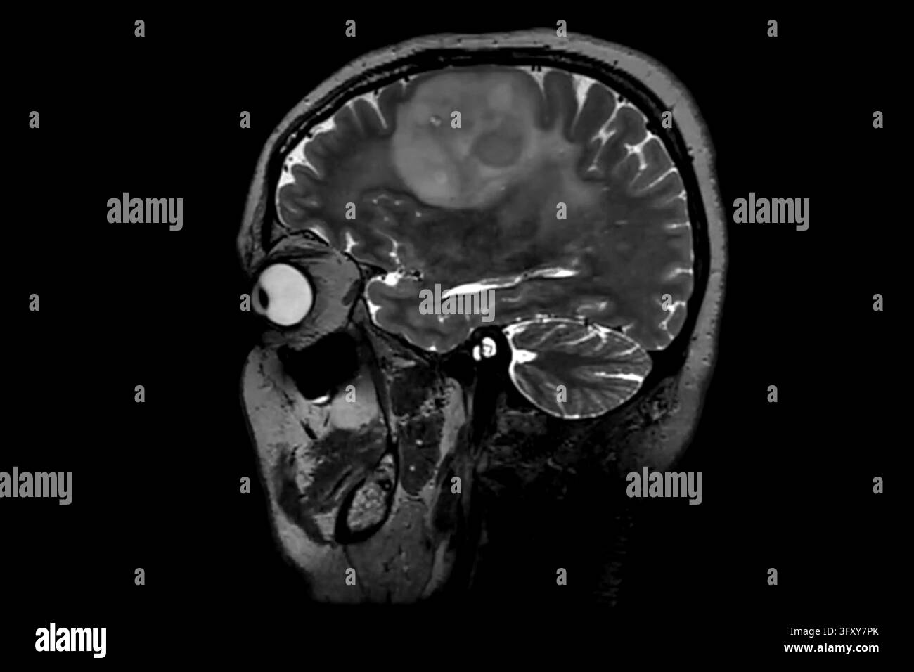 Imaging di risonanza computerizzata del cervello umano Foto Stock