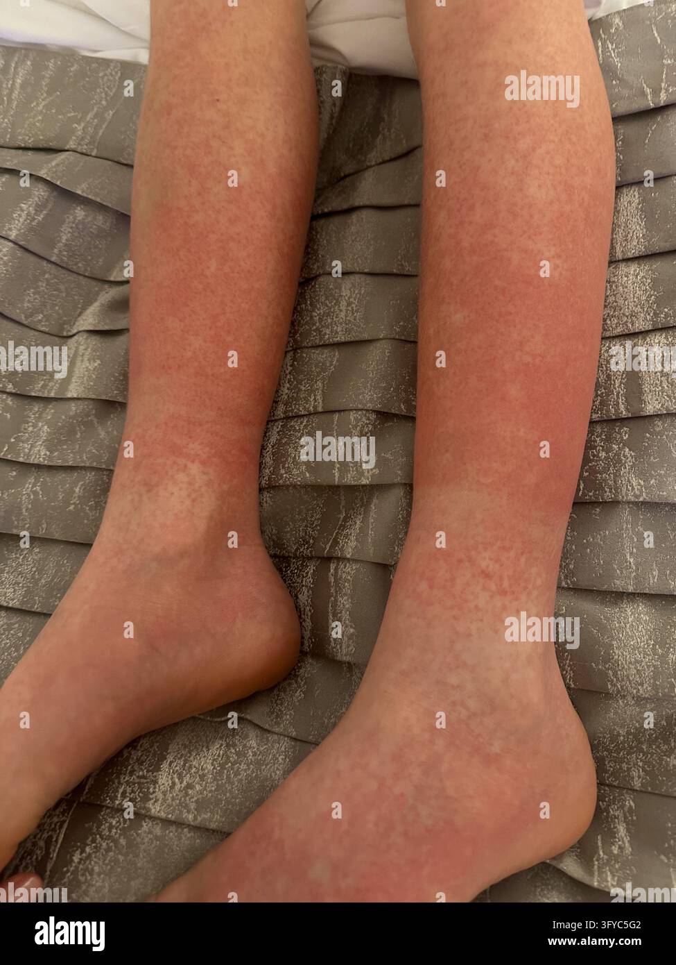Vista ravvicinata di un'eruzione cutanea rossa maculata su gambe e piedi inferiori su tessuto grigio. Vista ravvicinata di un'eruzione cutanea eritematosa rossa diffusa con piccole macchie che cop Foto Stock