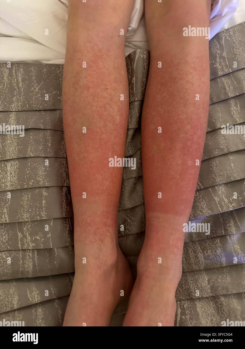 Vista dall'alto di un'eruzione cutanea rossa diffusa sulle gambe inferiori sdraiate su un tessuto a motivi. Vista dall'alto delle gambe inferiori che mostrano un'eruzione cutanea allergica rossa diffusa con sm Foto Stock