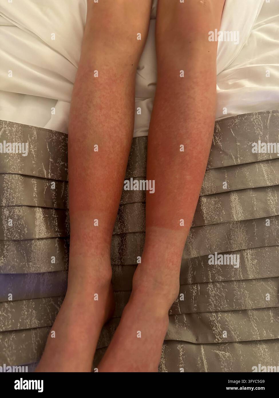 Vista completa delle gambe con grave eruzione cutanea rossa sulle lenzuola. Vista ad angolo alto che mostra un'eruzione cutanea allergica rossa e irritata che copre la parte inferiore delle gambe umane Foto Stock