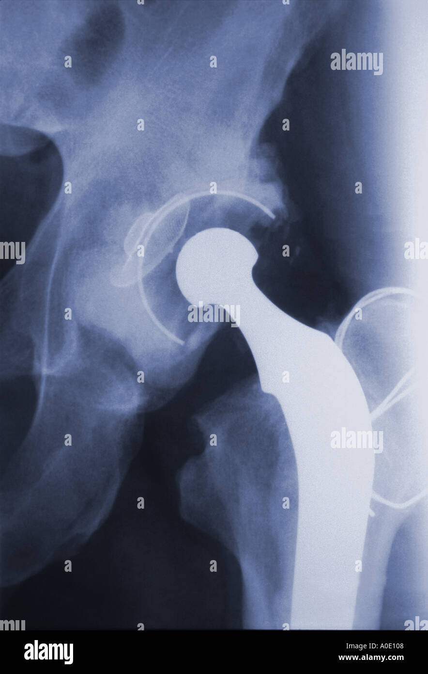 Articolazione artificiale dell'Anca X Ray Foto Stock