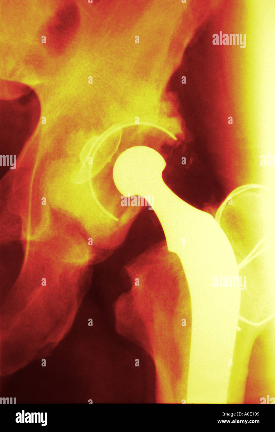 Articolazione artificiale dell'Anca X Ray Foto Stock