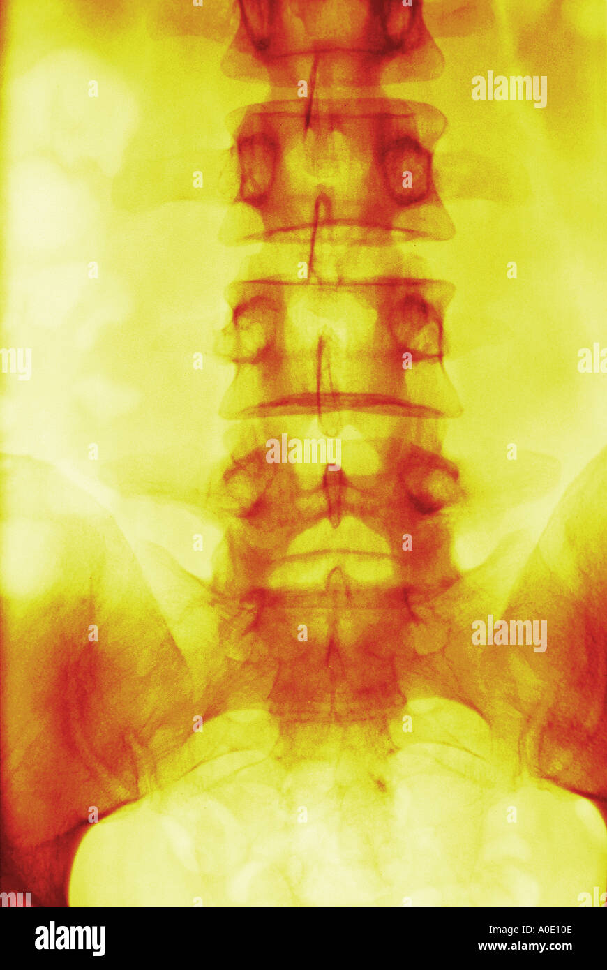 X ray della colonna lombare Foto Stock