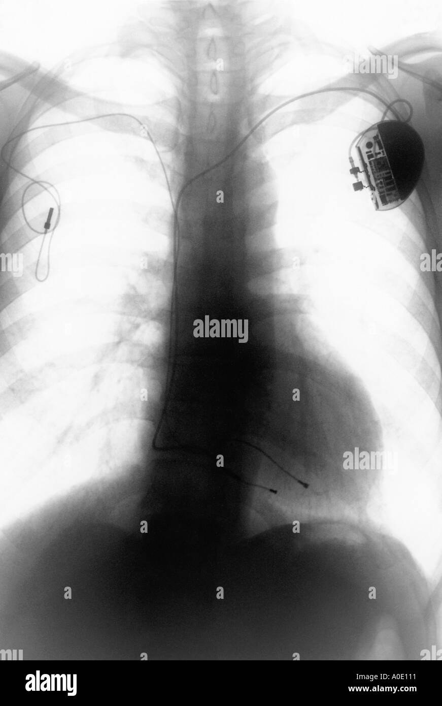 X ray di pacemaker cardiaco Foto Stock