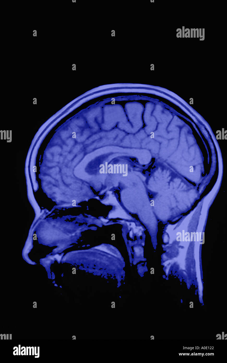 Esplorazione di MRI del cervello Foto Stock