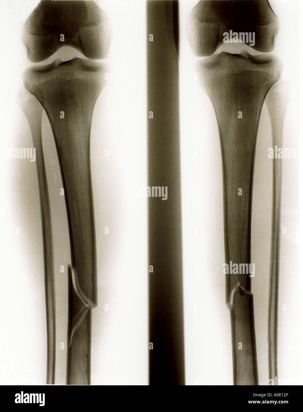 Fractured tibia immagini e fotografie stock ad alta risoluzione - Alamy
