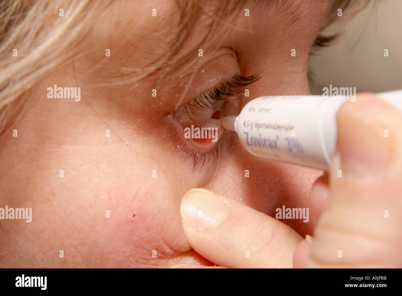 Medicare con occhio Zovirax gel per proteggere gli occhi da herpes zoster  in faccia Foto stock - Alamy