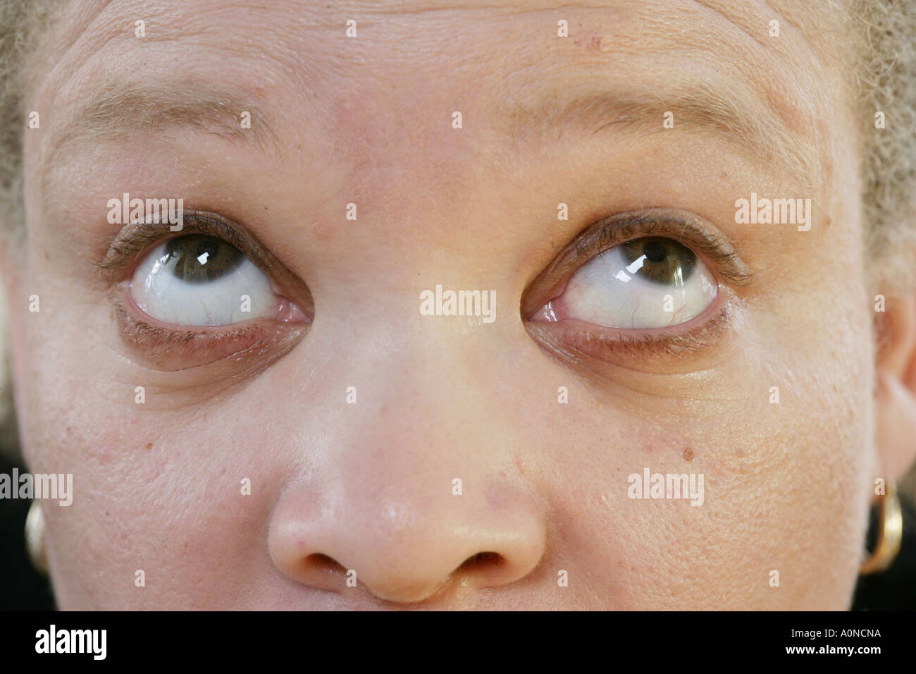 Il nistagmo: involontari, ritmico, oscillazioni ripetute di uno o entrambi  gli occhi Foto stock - Alamy