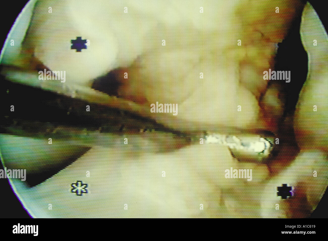 Sonda metallica esplora l'interno di una donna di ginocchio durante la chirurgia artroscopica in Massachusetts Foto Stock