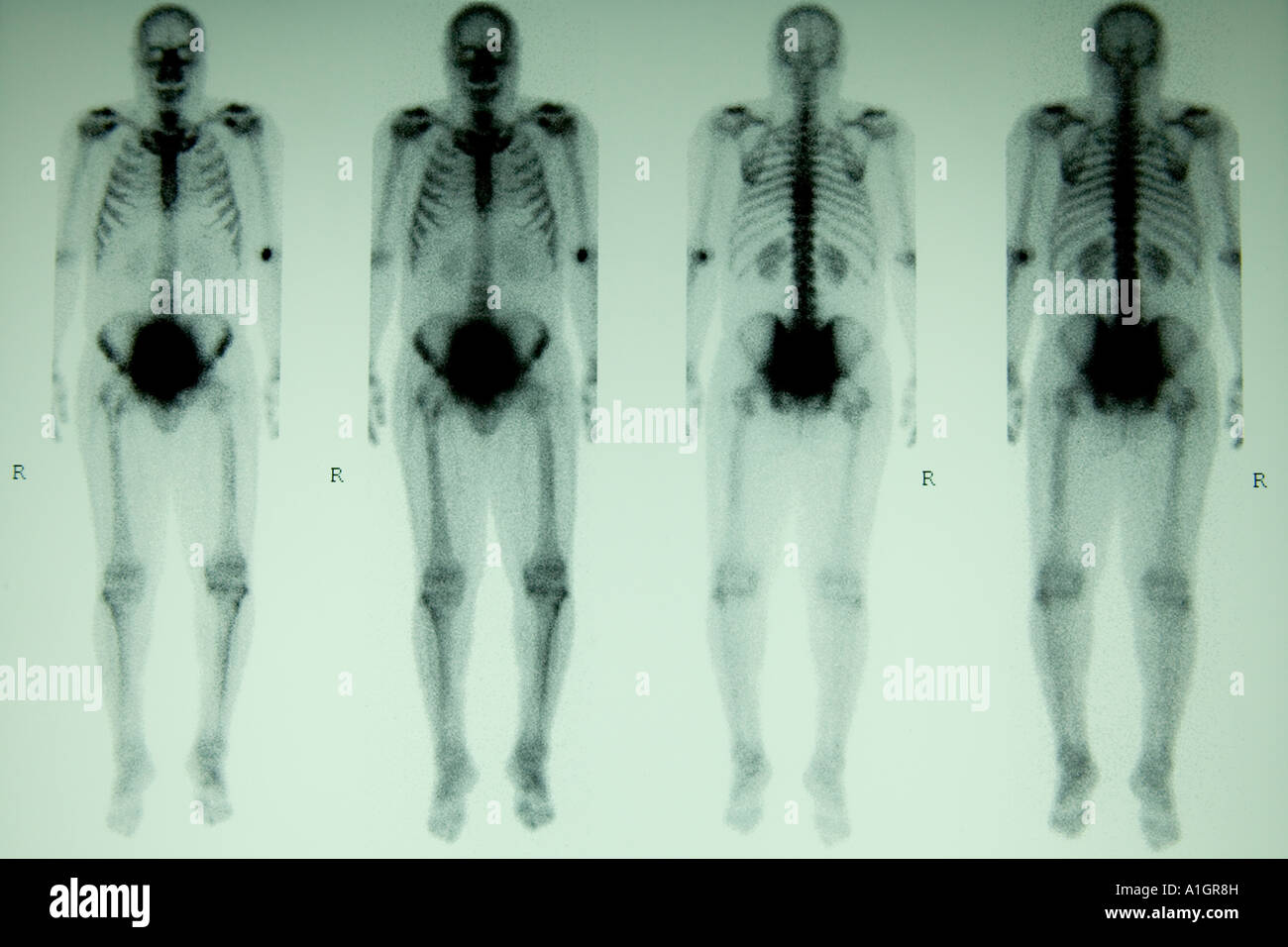 Osso nucleari scansione, corpo pieno a tre fasi, Foto Stock