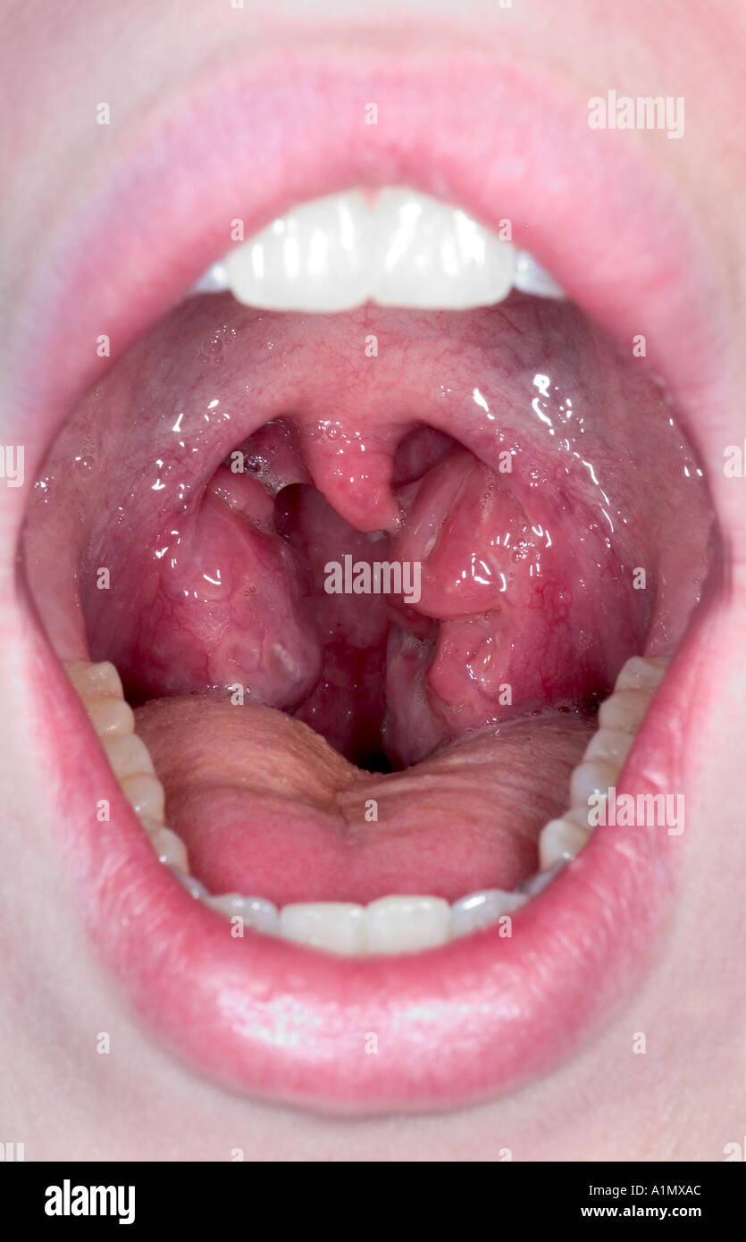 Strep gola infezione Foto Stock