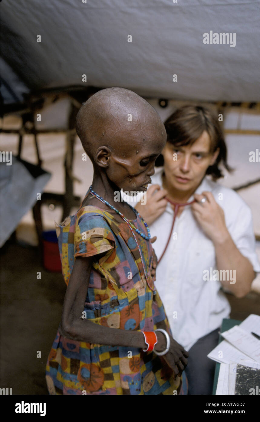 La carestia Medecins sans frontieres MSF medico belga trattare gravemente malnutriti bambino 1998 Foto Stock