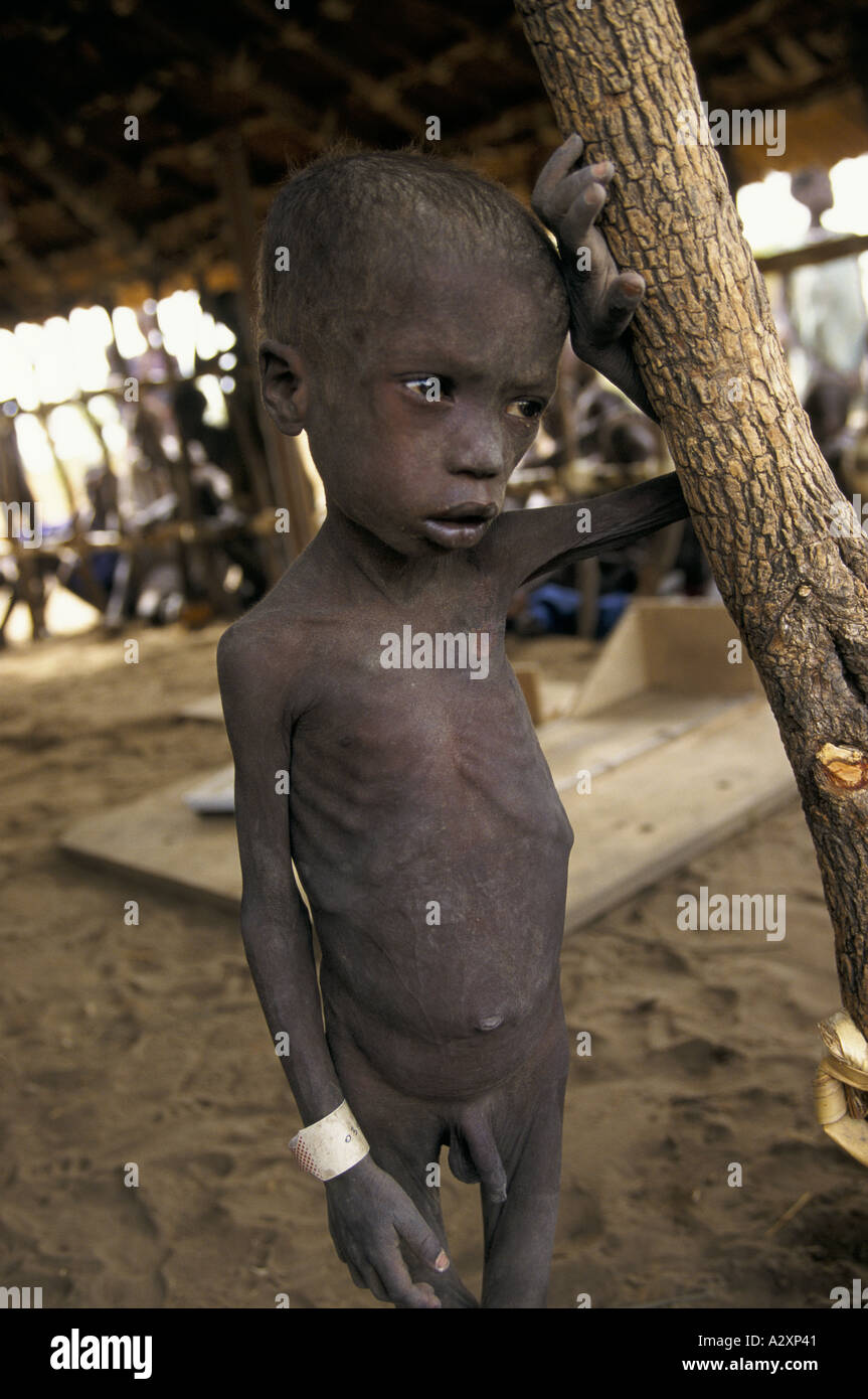 Bambino malnutrito immagini e fotografie stock ad alta risoluzione - Alamy