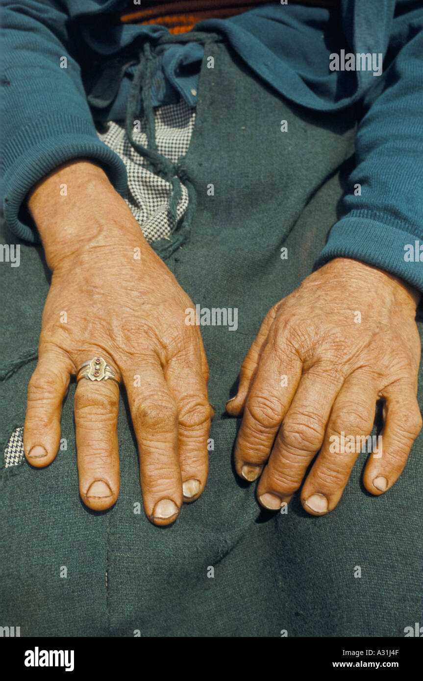 Close up old Lady s mani anello sul dito rughe linee chiodi ruvida con segni di sporco tagli sulla punta delle dita delle mani sul verde di abbigliamento Foto Stock