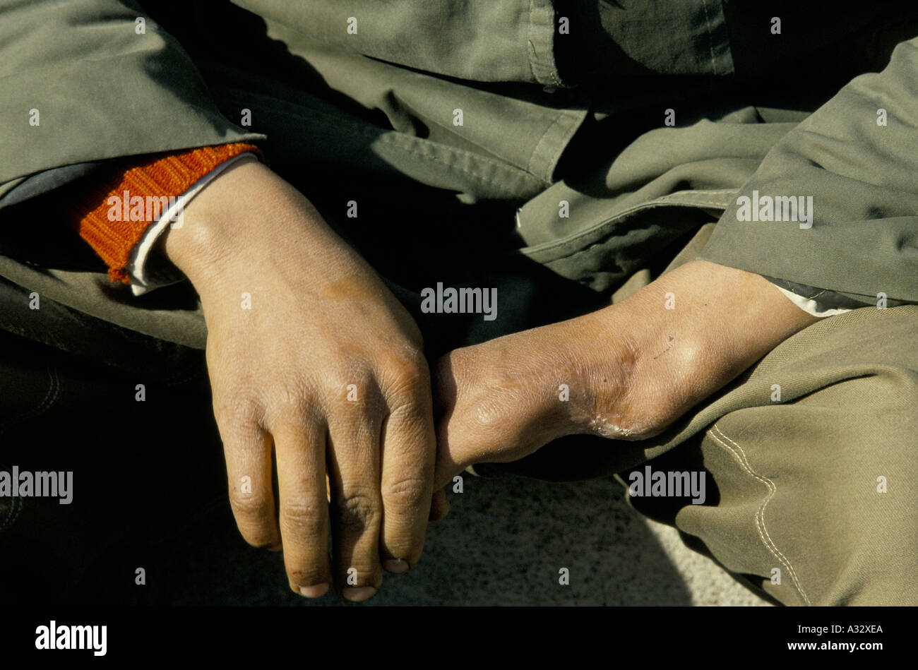 Le mani di un ragazzo che ha perso le dita, risultante da giocare con un "Butterfly" mina Iraq Kurdistan: Foto Stock
