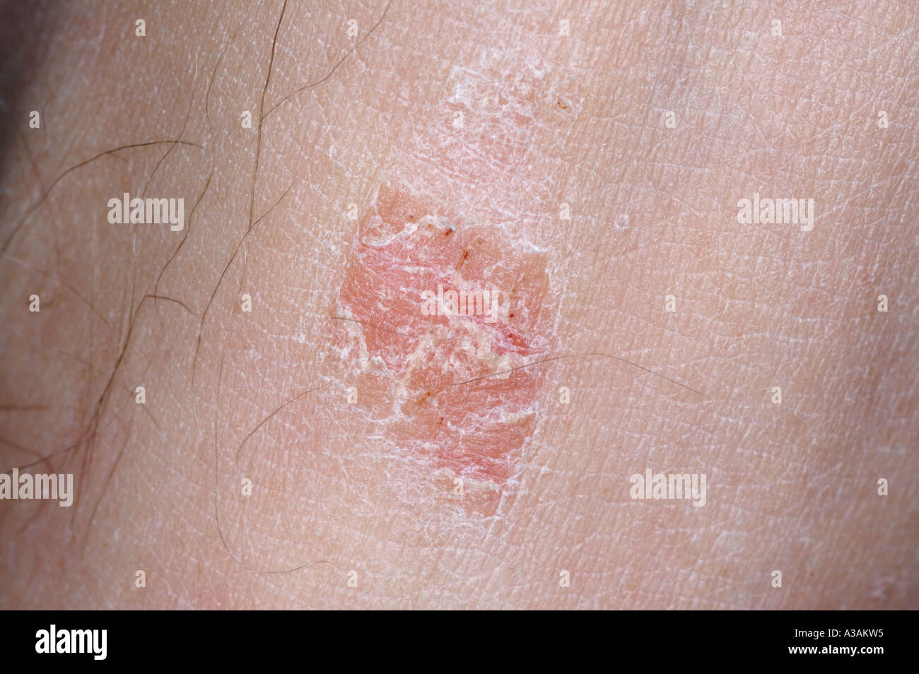 Psoriasi a placche close-up sulla gamba. Foto Stock