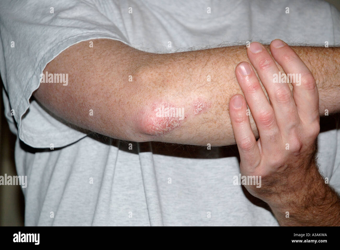 Psoriasi a placche su un gomito e dita Foto Stock