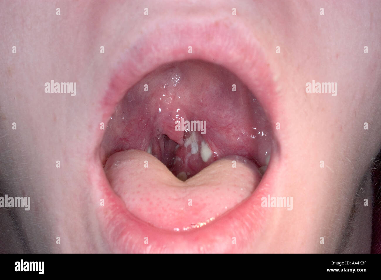 Strep gola infezione Foto Stock