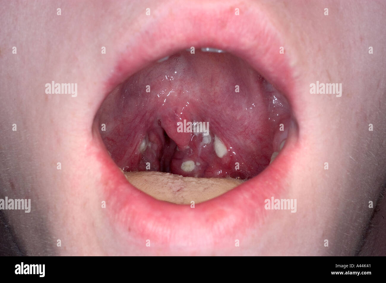 Strep gola infezione Foto Stock