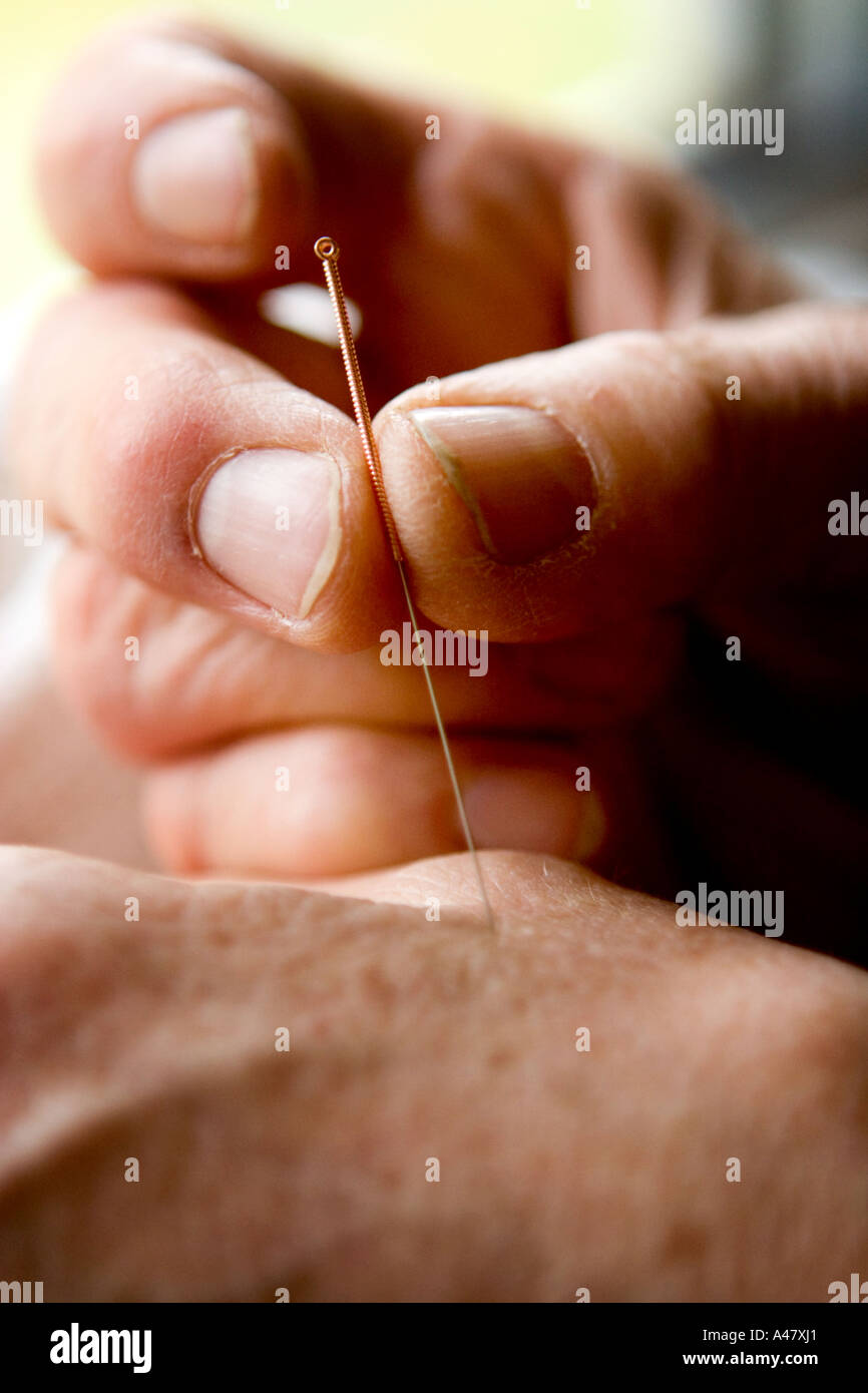 Accupuncture è eseguita su un paziente in cerca di medicina alternativa. COPYRIGHT fotografia da Jamie SIMPSON +447949696983 Foto Stock