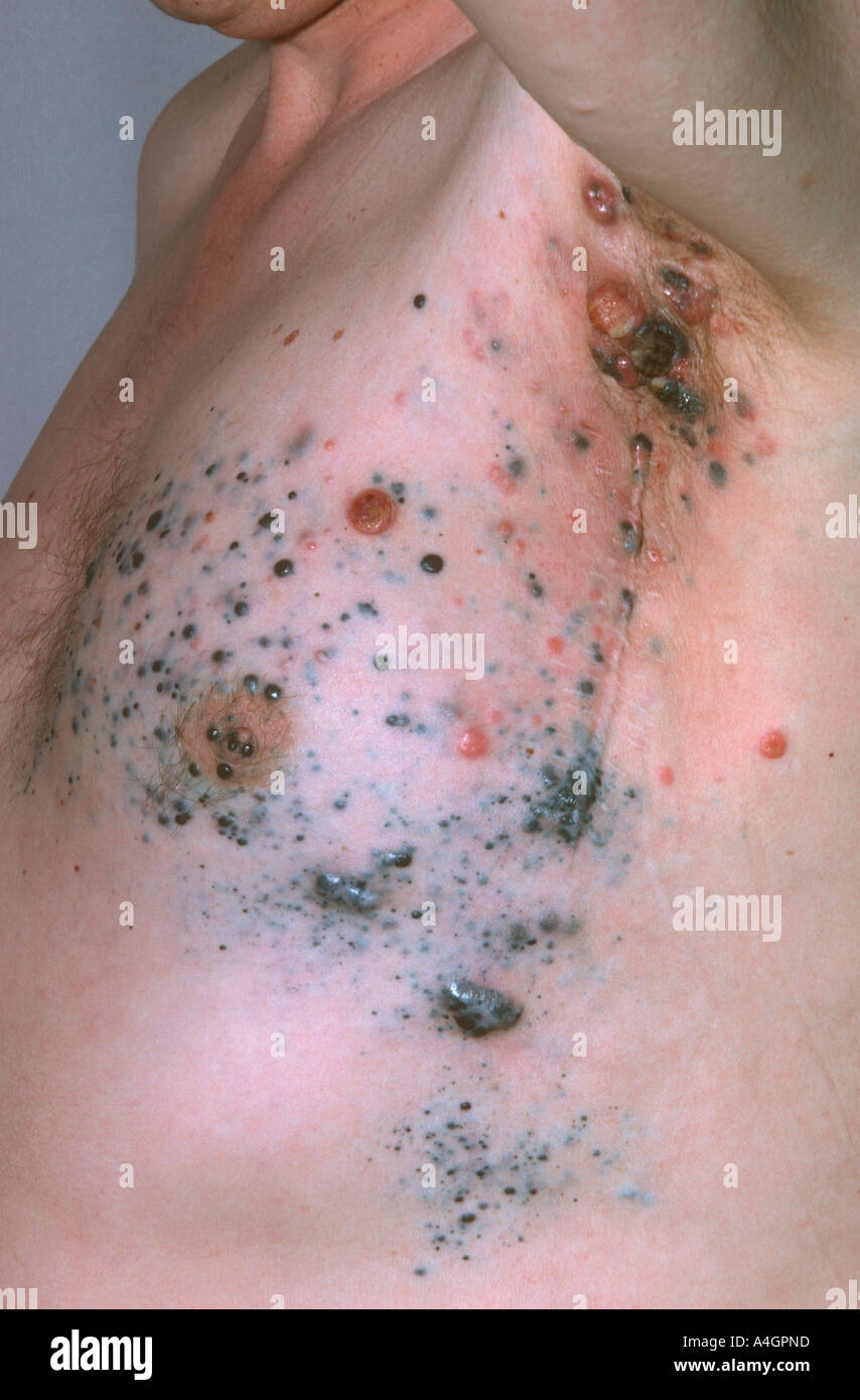 Il melanoma maligno Foto Stock