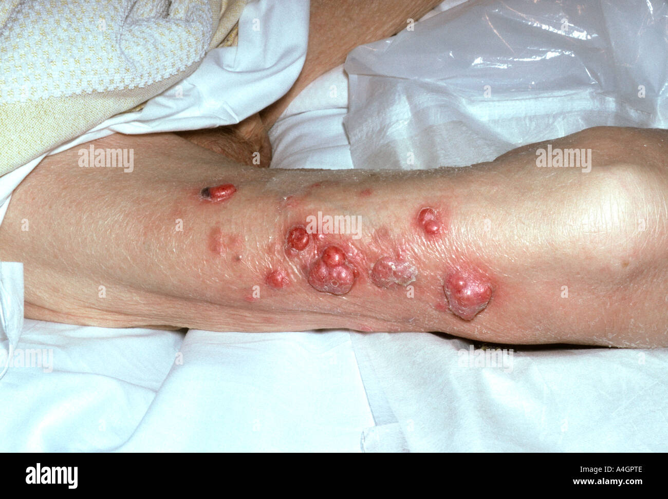 Il melanoma maligno è una grave forma di cancro alla pelle Foto Stock