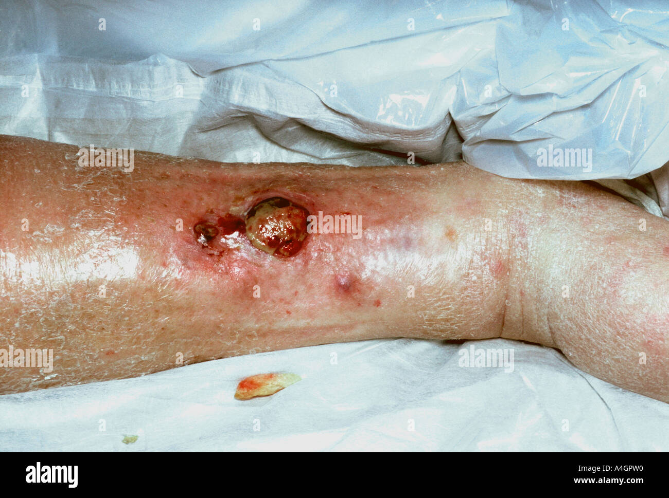 Il melanoma maligno è una grave forma di cancro alla pelle Foto Stock