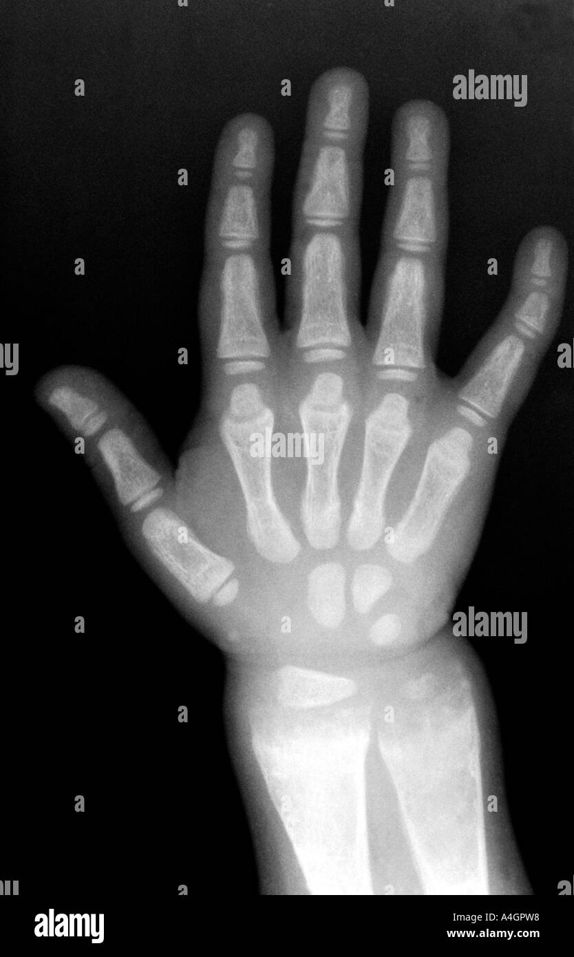 Un x-ray della mano di un bambino con il rachitismo, una infanzia disturbo che coinvolge il rammollimento e un indebolimento delle ossa. Foto Stock
