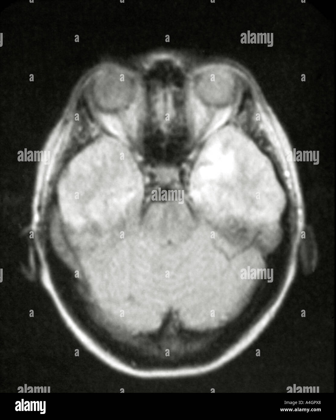 Una risonanza magnetica nucleare (NMR) scansione di un paziente con un glioma Foto Stock