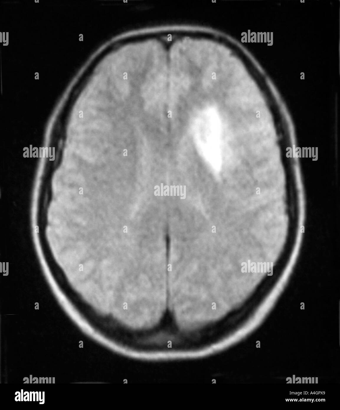 Una risonanza magnetica nucleare (NMR) scansione di un paziente con un glioma Foto Stock