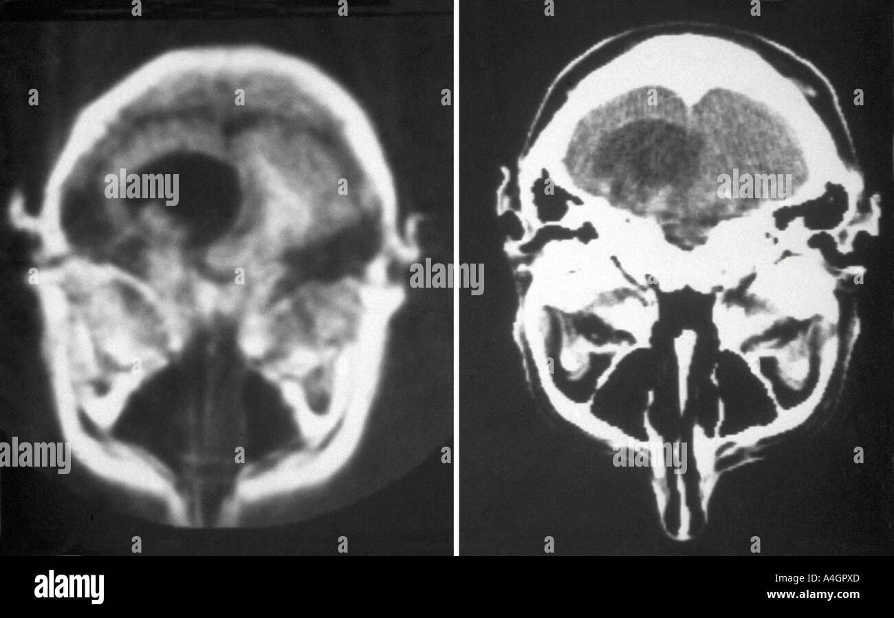 Scansione CT (sinistra) e una scansione di NMR (destra) di un astrocitoma cerebrale, tumori che originano da cellule del cervello chiamato astrociti Foto Stock