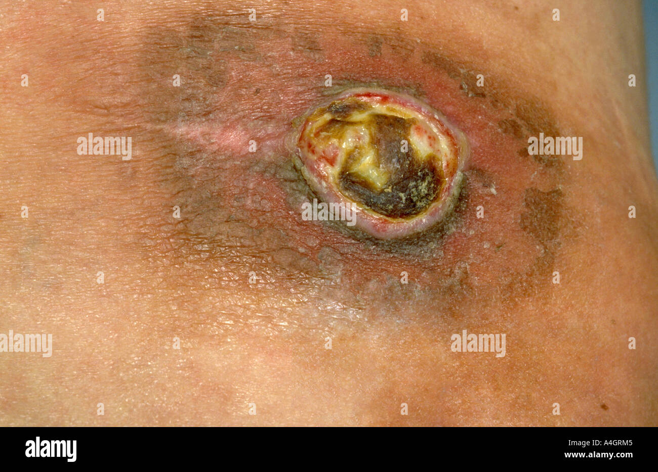 Un melanoma maligno è un neoplasma derivato da cellule che sono in grado di formare la melanina Foto Stock