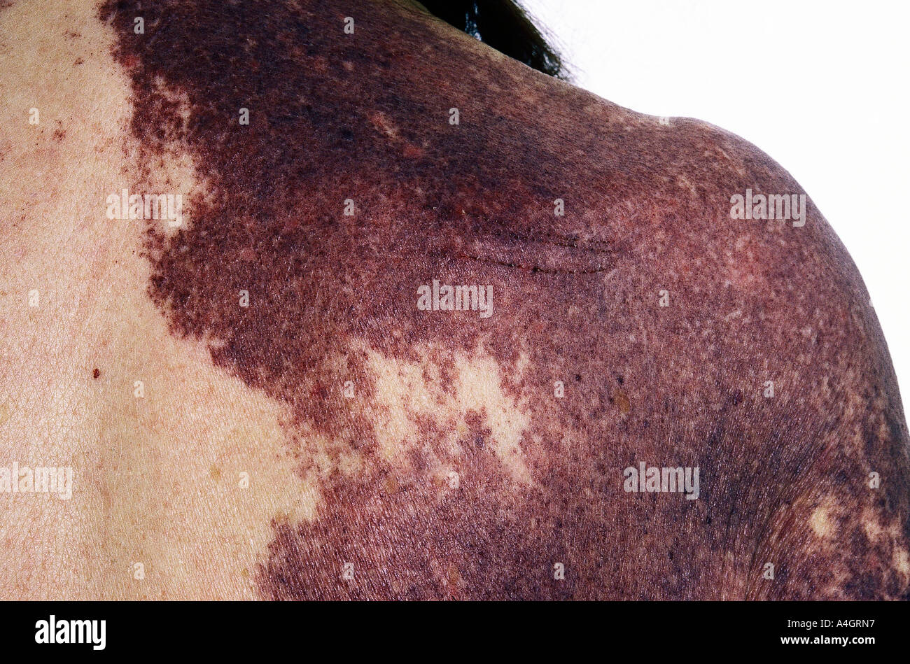 Una fotografia di un paziente con una estesa Macchia di vino porto copertura della spalla e del braccio Foto Stock