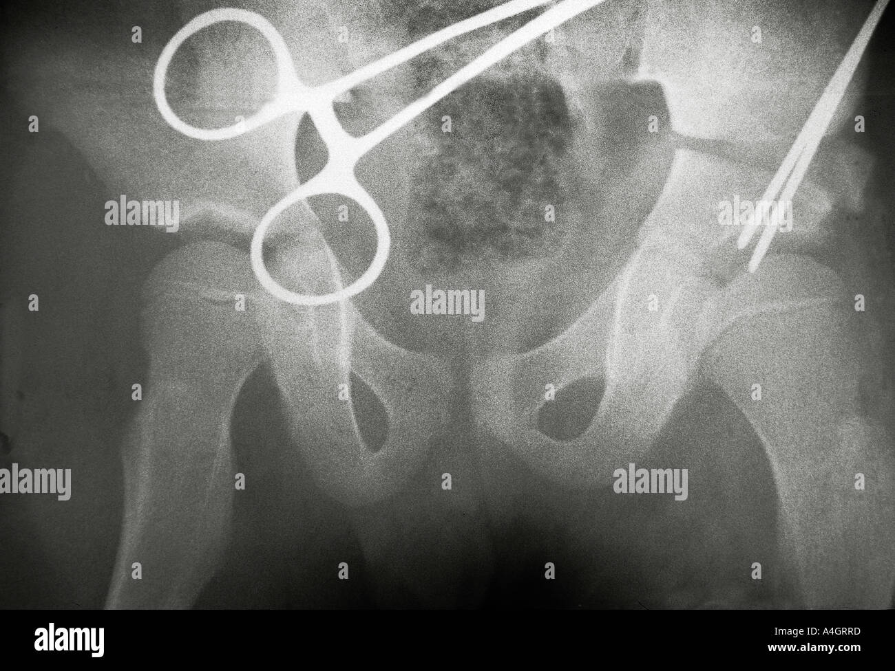 A raggi x che mostra coxa magna, allargamento e la deformazione della testa del femore Foto Stock