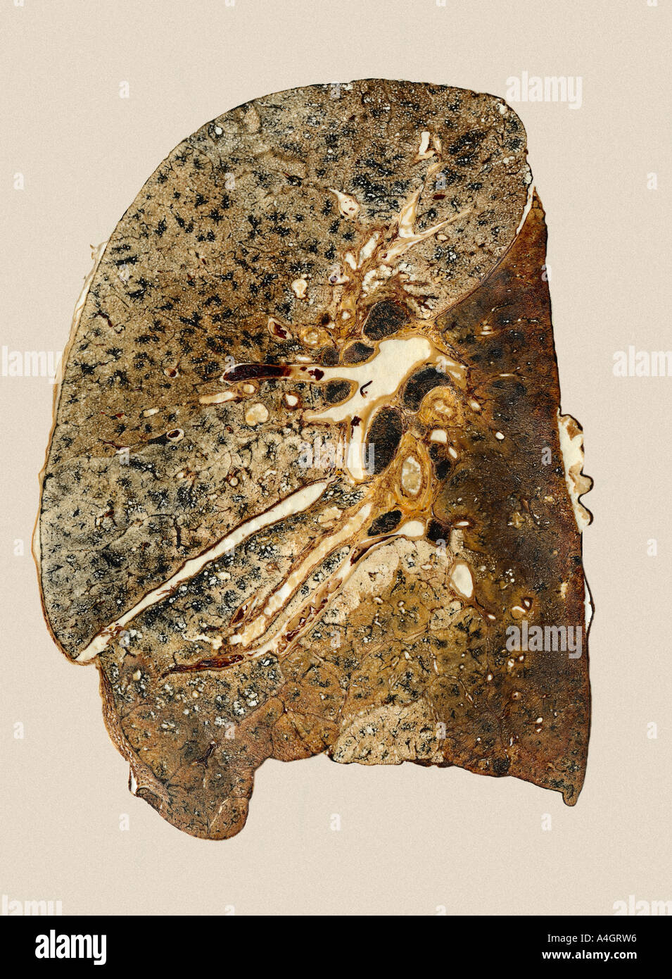 Parte della collezione Gough-Wentworth. Una sezione ai polmoni di un paziente che è morto di polmonite ipostatica Foto Stock