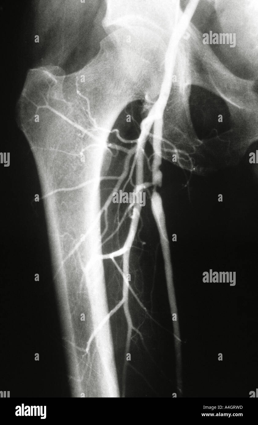 Un angiogramma, chiamato anche arteriogram, della gamba che mostra l'arteriosclerosi dell'estremità. Foto Stock