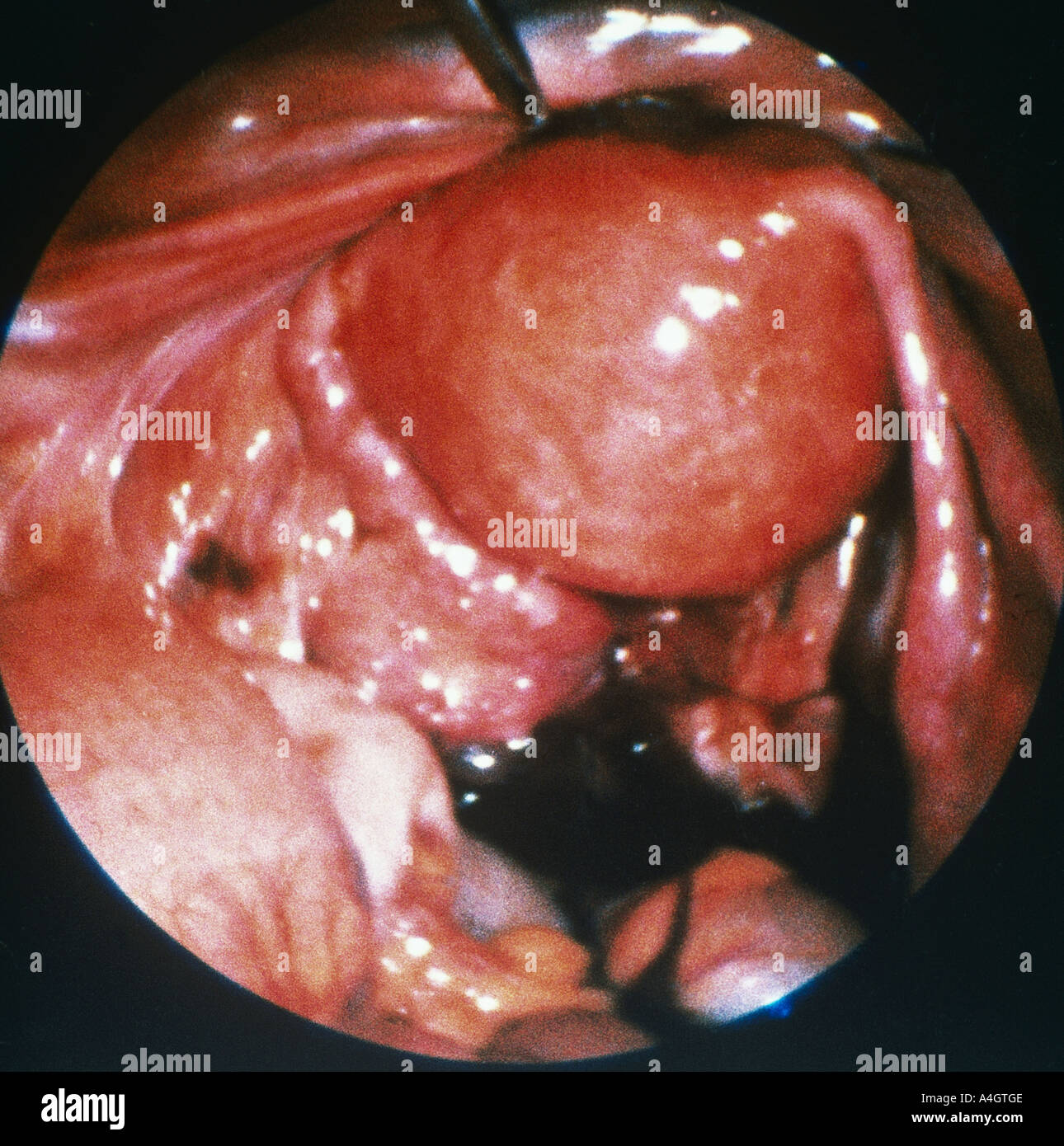 Un'immagine endoscopica presa attraverso un laparoscopio mostra endometriosi nella sacca di douglas e sulla piega uterovesical Foto Stock