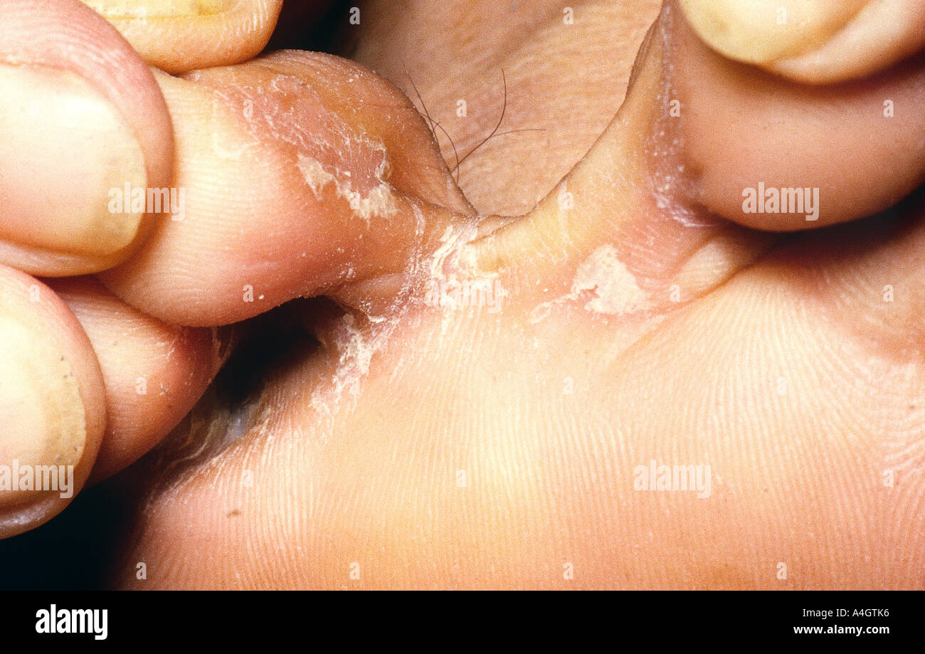 Il piede d'atleta è una infezione dei piedi causate da funghi Foto