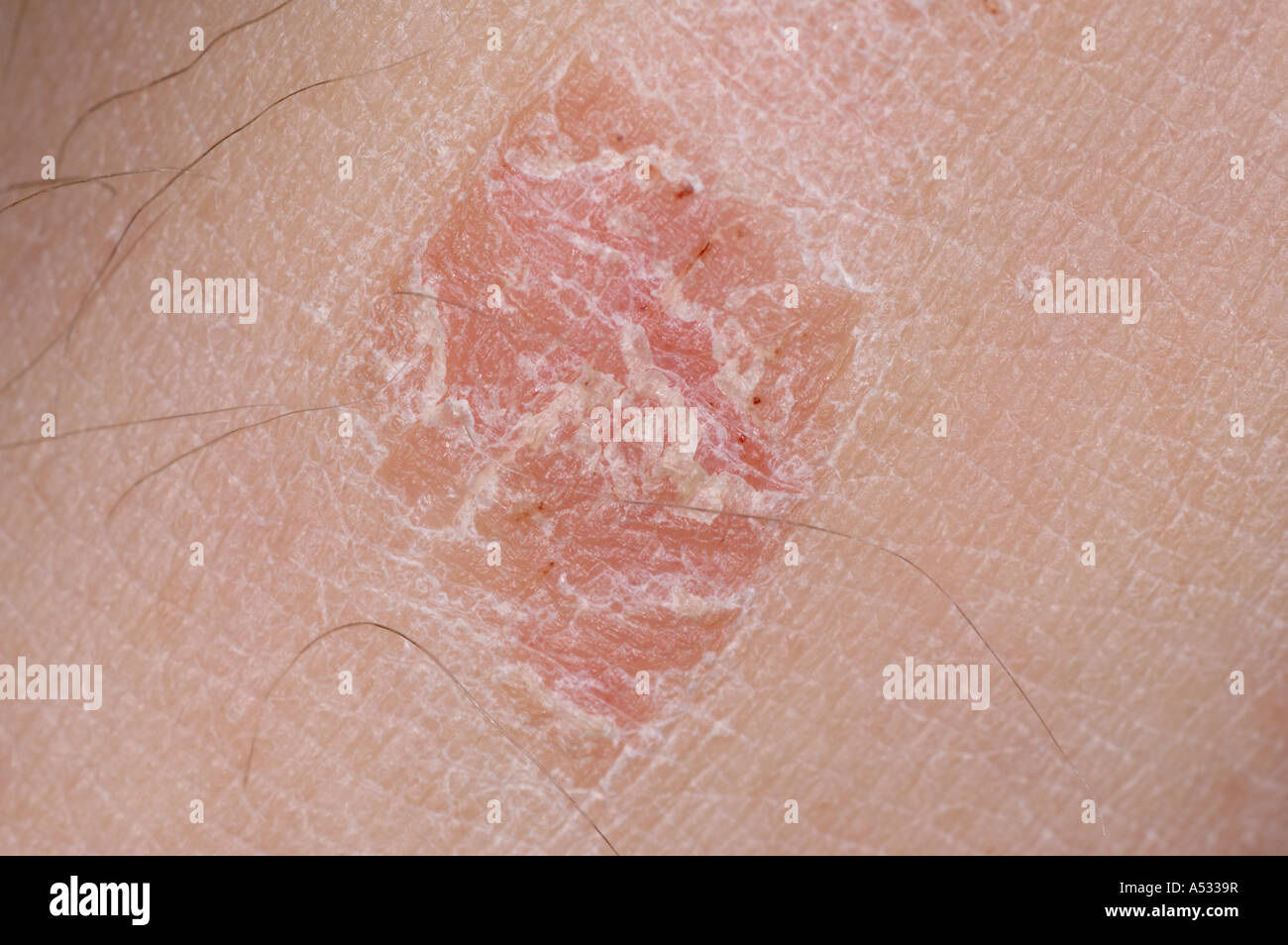 Psoriasi a placche close-up sulla gamba. Foto Stock