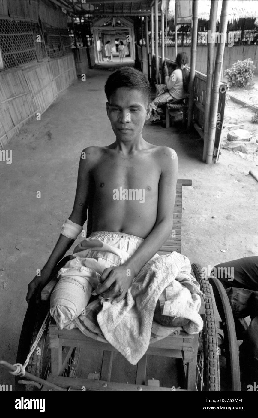 Painet ha1408 233 in bianco e nero uomo guerra maschio legless esplosione in miniera vittima ospedale confine tailandese cambogia paese Foto Stock