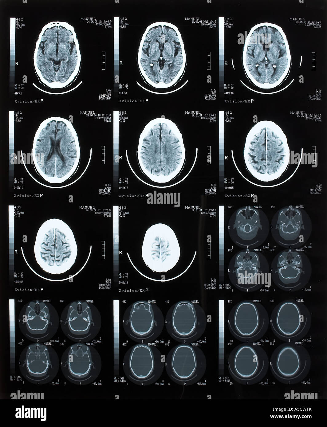 Tomografia cerebrale Foto Stock