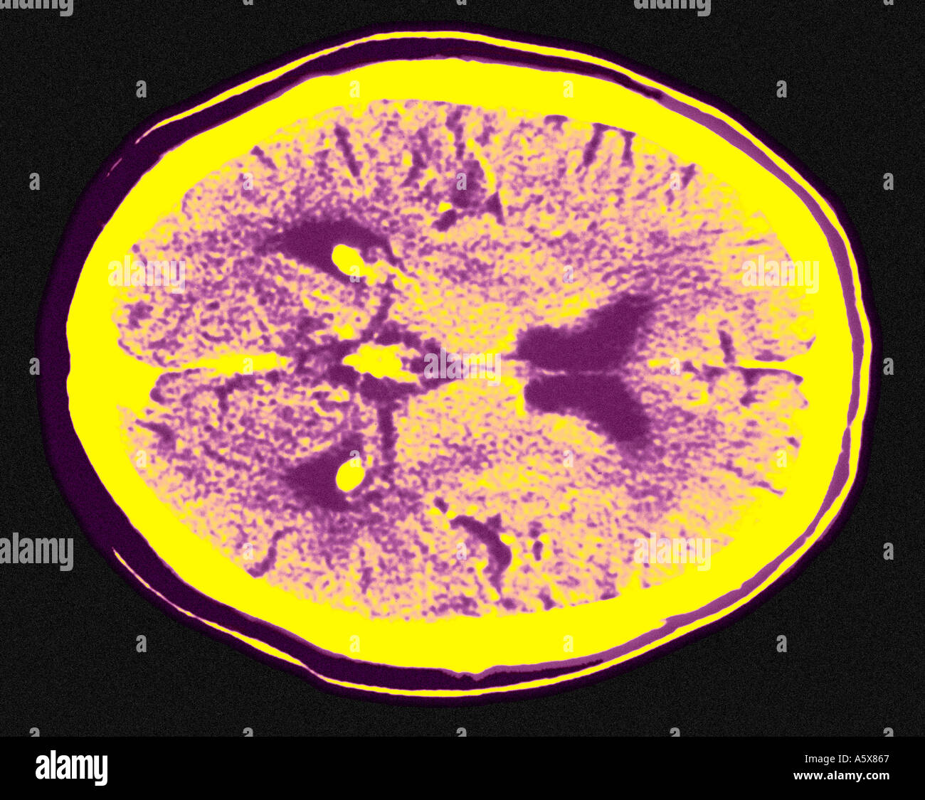 CAT scan del cervello sezione assiale illustrante i ventricoli Foto Stock