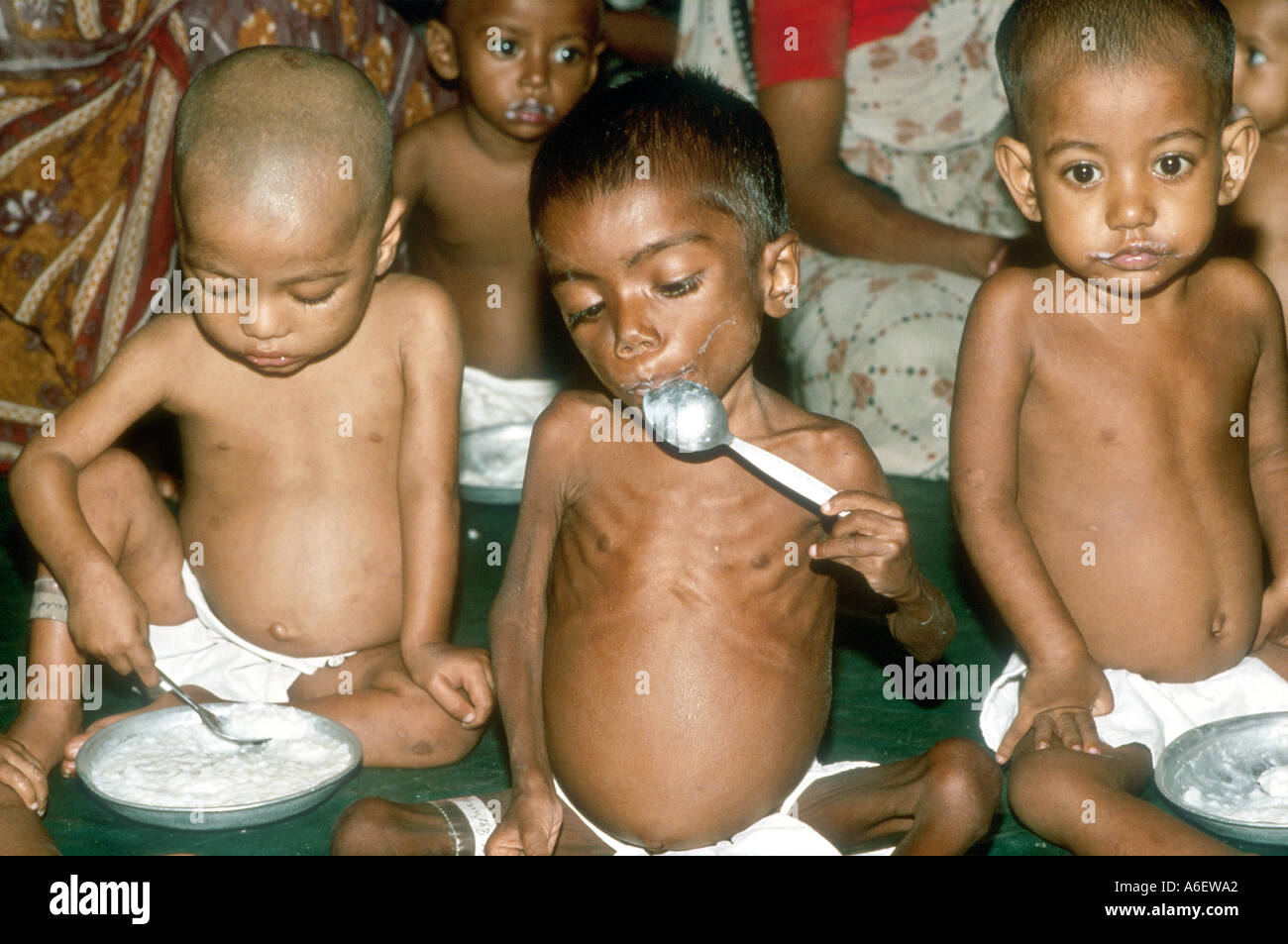 Bambini malnutriti mangiare alimenti ad alto contenuto proteico. Nutrizione infantile, unità di Dacca in Bangladesh Foto Stock